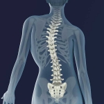 Scoliosis