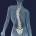 Scoliosis